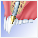 インプラント