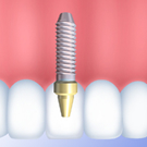 インプラントの長所・短所