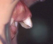 出っ歯（上顎前突） 術前