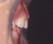 出っ歯（上顎前突） 術後