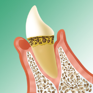 初期歯周炎イメージ