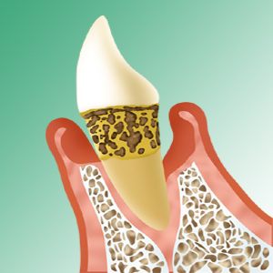中期歯周炎イメージ