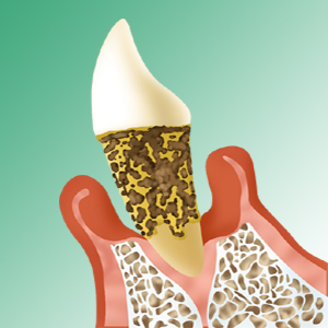 末期歯周炎イメージ