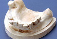 現状の歯形模型（上顎）