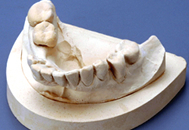 現状の歯形模型（下顎）